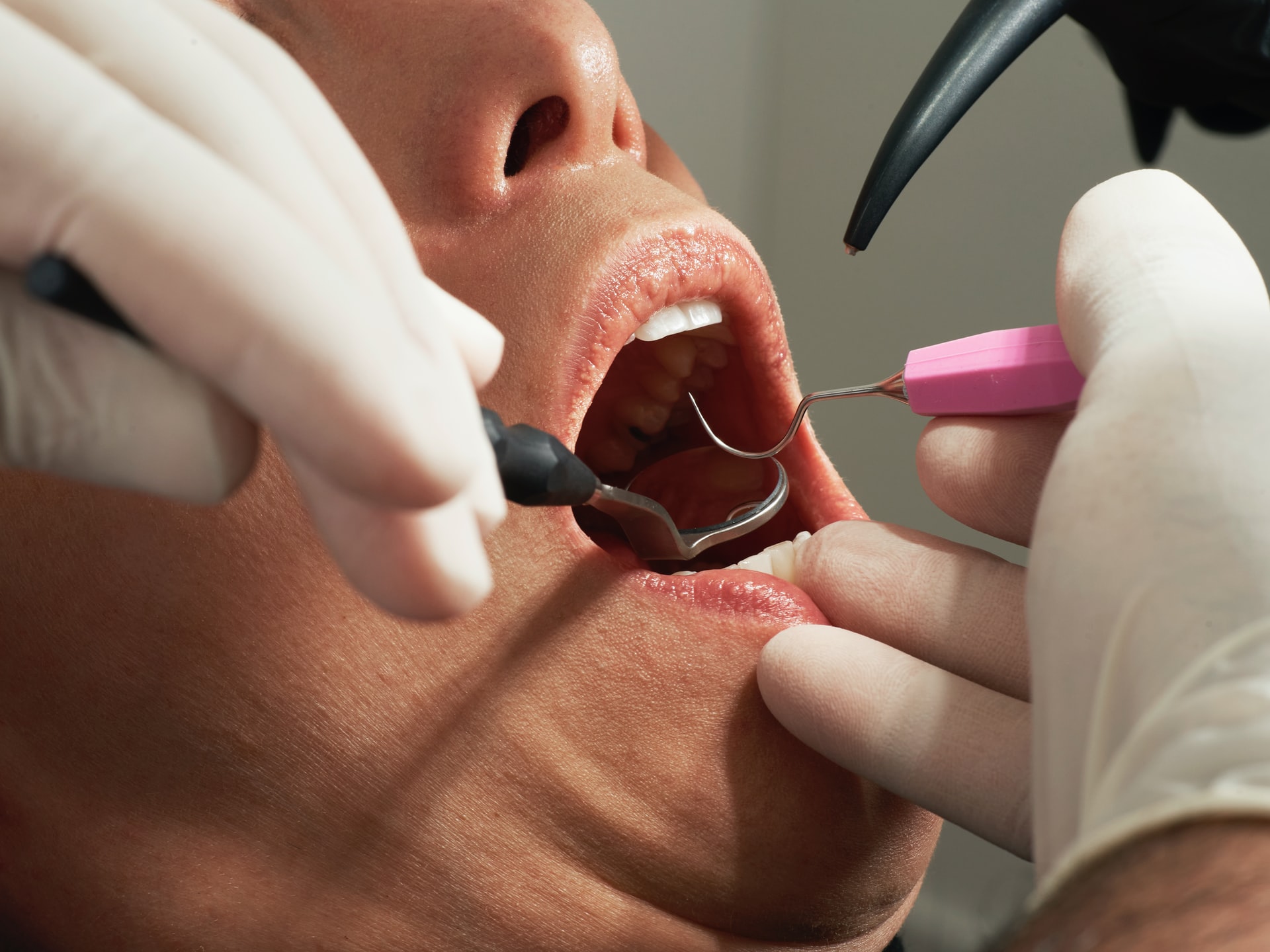 Un paziente con la bocca aperta che viene sottoposto a cure odontoiatriche con strumenti specifici