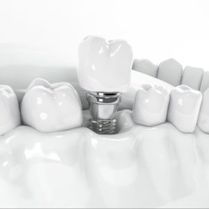 immagine sintetica di un impianto dentale su una dentatura