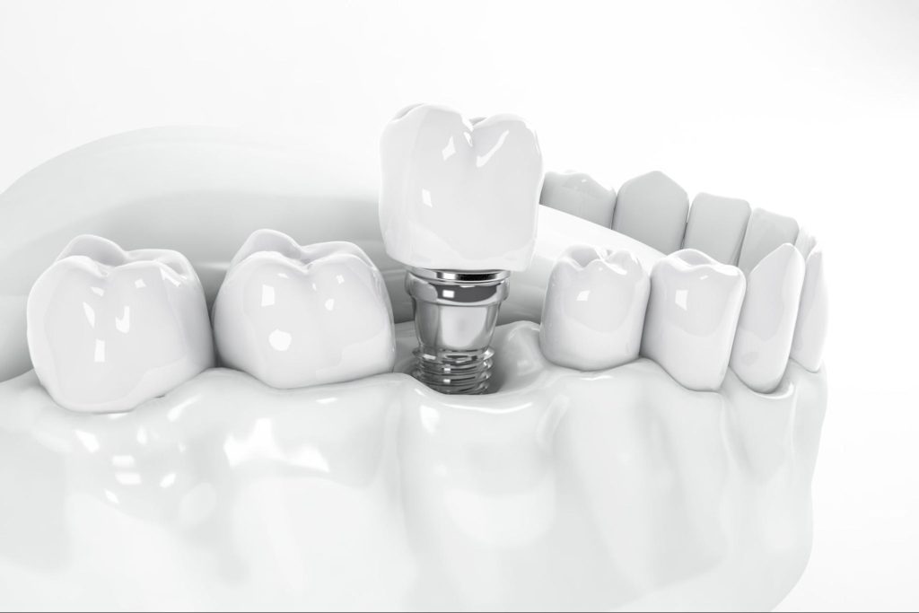 immagine sintetica di un impianto dentale su una dentatura
